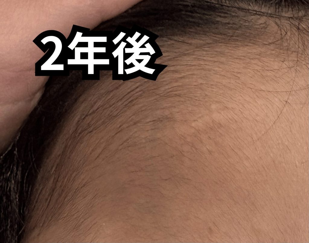 子どものおでこ傷あと2年後の写真